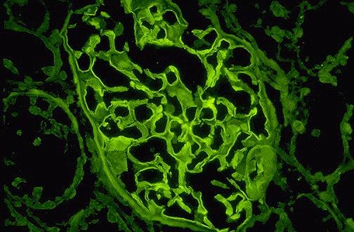 Immunofluorescence stain for IgG: Questions for everyone to consider: Does this glomerulus look normal? If not, what structures appear altered?