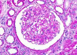 C. MEMBRANOUS NEPHROPATHY CC/HPI: A 47 year old female with a history of chronic hepatitis B infection complains of weight loss, progressive