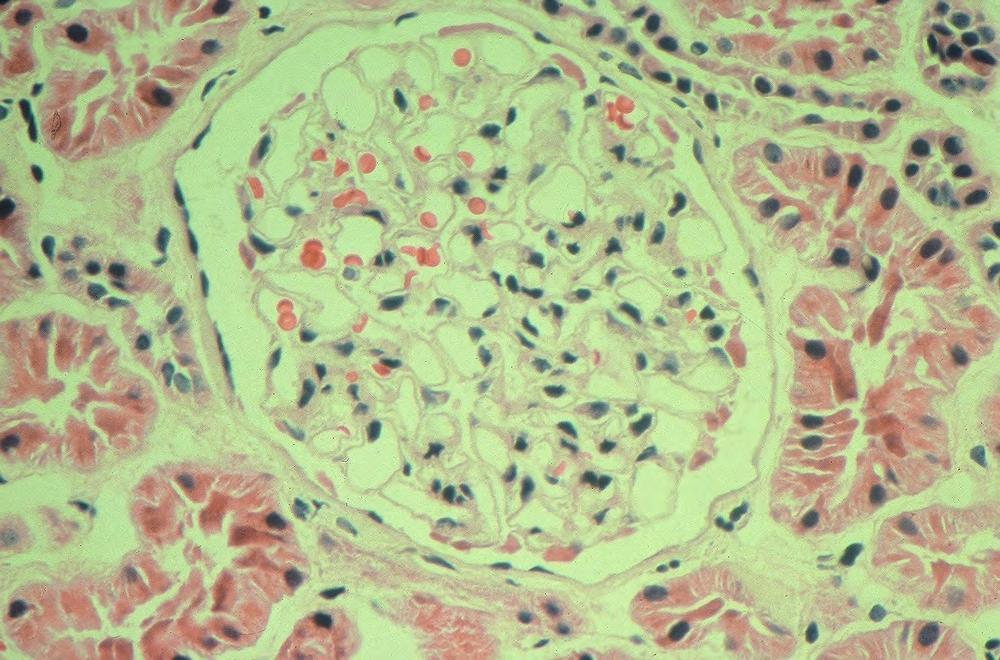 How does the microscopic appearance of the patient s glomerulus
