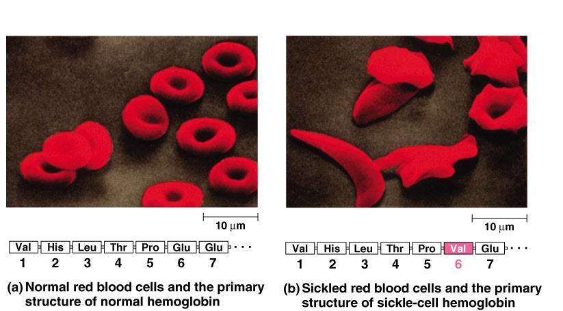 Sickle cell anemia Substitution of one amino acid in