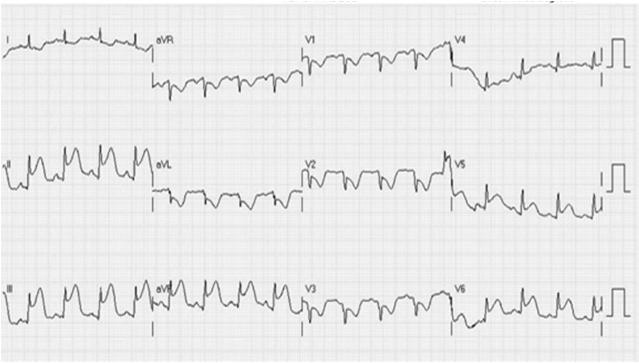 Always look for the reciprocal changes Posterior: R wave and ST depression