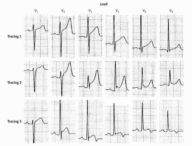 Electrocardiograms Showing Normal ST-Segment Elevation and
