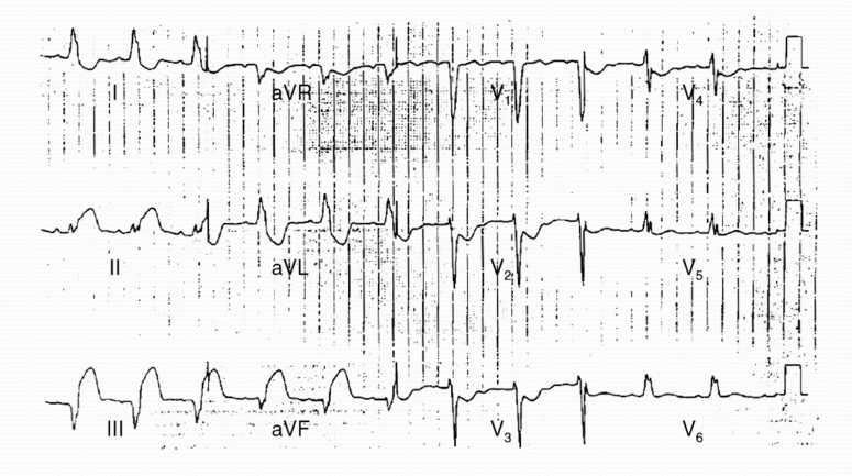Electrocardiographic diagnosis of evolving acute MI in the