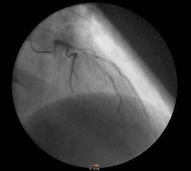 Case #3 coronary angiography