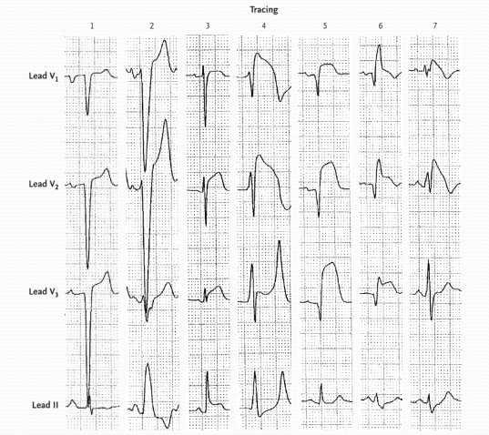 Electrocardiograms Showing ST-Segment Elevation in Various
