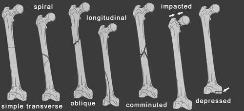 F R A C T U R E S Traumatic Fractures Location Laterality Which bone? Which part of the bone?