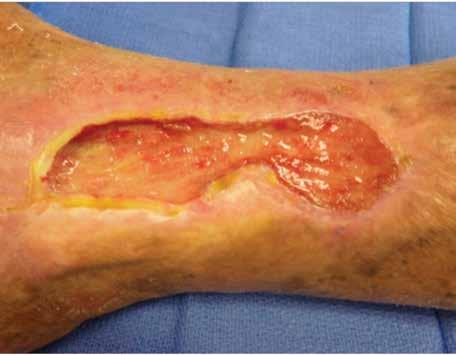 An example of these cases is this patient with a DFU (Table 1). Bacterial levels in the wound tissue decreased from 10 6 CFUs/to <10 2 CFUs/gm of tissue.