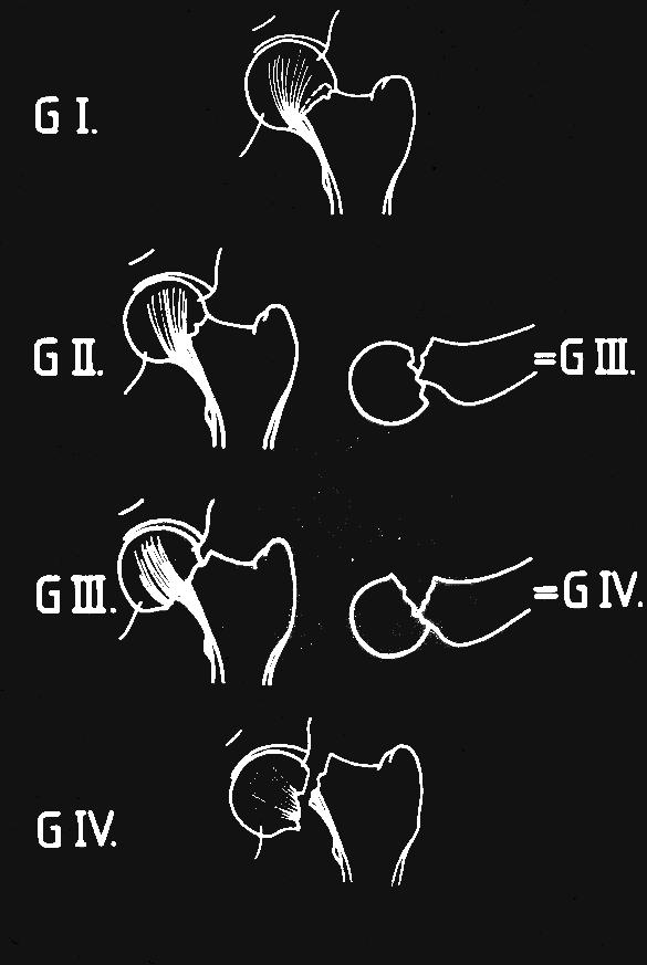 CLASSIFICATION OF MEDIAL FEMORAL Garden I. Impacted, valgus, abduction fracture Garden II. Non-displaced fracture Stable NECK FR.