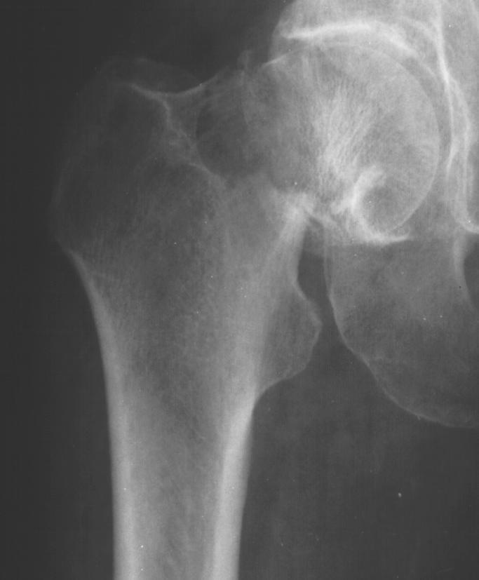 FEMORAL NECK FRACTURE: avascular necrosis 15-30 % stable osteosynthesis? it is less dangerous to life.
