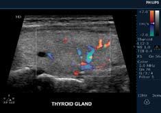 Color flow imaging with the L12-3 linear array transducer enables assessment of vasculature in superficial imaging, as shown in this thyroid.