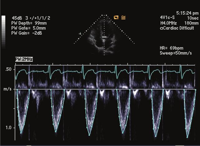 For example, M-mode measurements of left and right ventricular dimensions and wall thicknesses are extracted at diastole and systole.