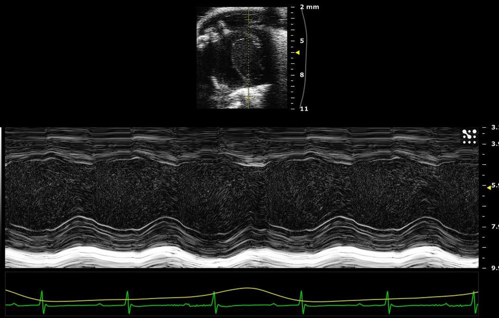 Parasternal Short Axis View in M-Mode M-Mode axis should be placed at the mid-level of the LV, usually just medial of the papillary muscle.