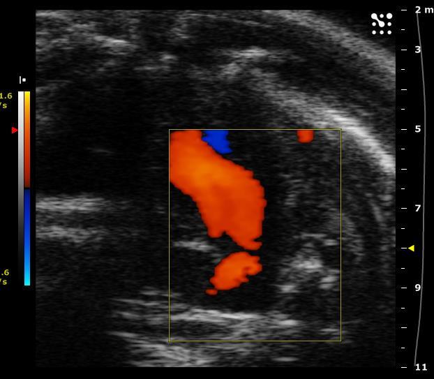 Figure 14 - B-Mode Apical 4 Chamber image displaying the apex at the top of the image, the left and partial right ventricles and mitral and
