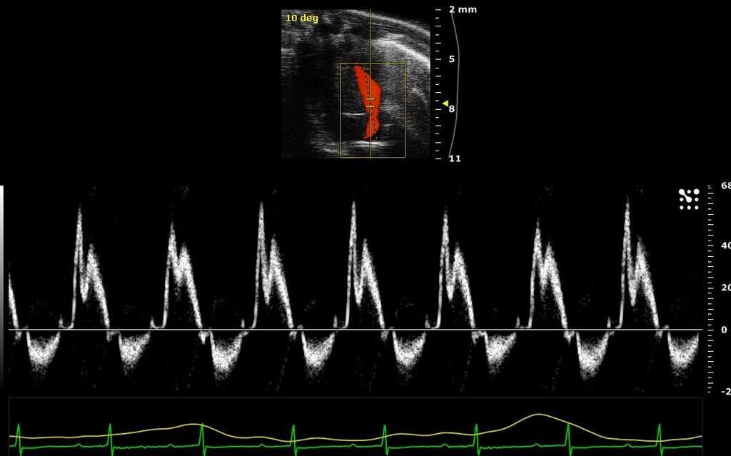 Apical Four Chamber View Mitral Flow display in PW Doppler Mode Figure 16 -