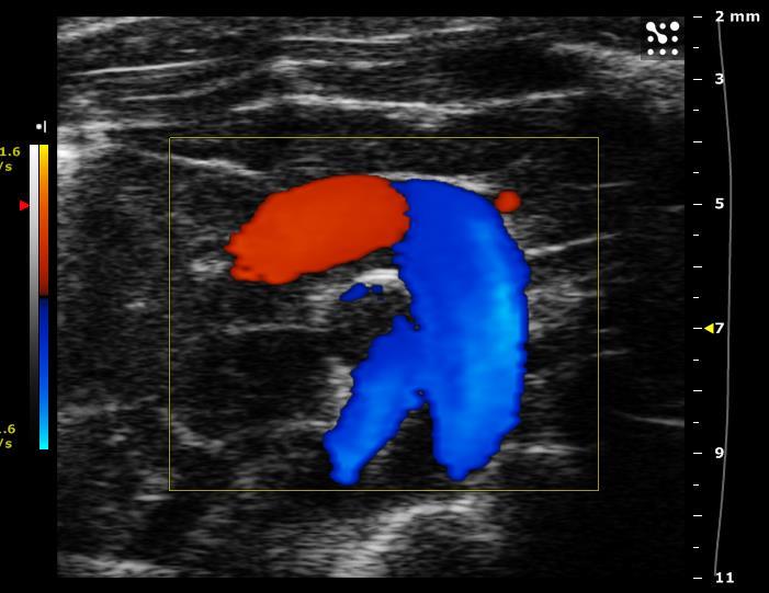 Aortic Arch View in Color Doppler Mode Figure 21 Color Doppler image