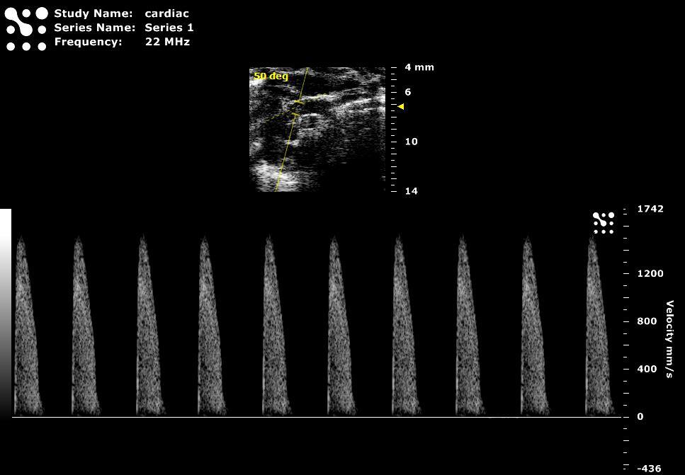 and Descending aorta Aortic Arch in PW Doppler Mode Figure 22 Flow