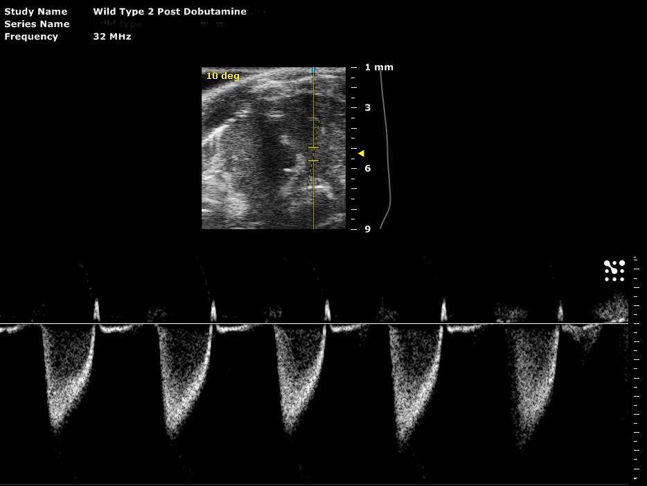 Measurements and Calculations for Right Ventricle Measurements RVOT PV