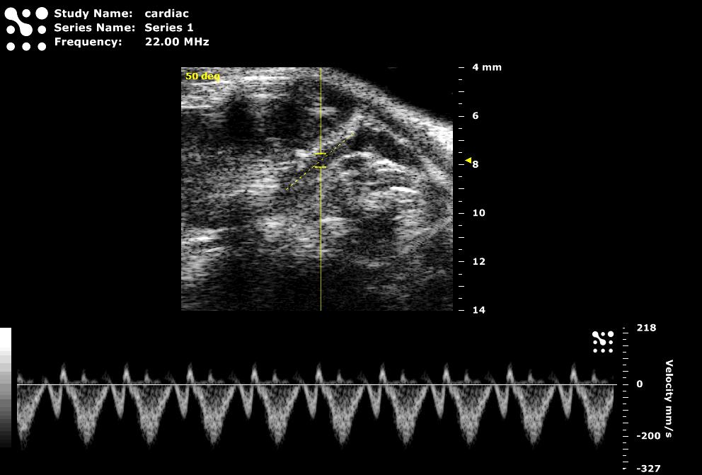 Superior (Cranial) Vena Cava Flow Display in PW Doppler Mode The right and left superior vena cava generally run parallel to the aorta and