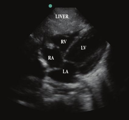 Figure 15 The subxiphoid view, with the liver shown anteriorly. (RV=right ventricle, LV= left ventricle, RA= right atrium, LA= left atrium.) Figure 17 The parasternal long-axis view.