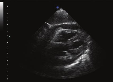 Figure 16 Subxiphoid view of a 2-year-old child with dilated cardiomyopathy and a circumferential pericardial effusion. Figure 18 The parasternal long-axis view.