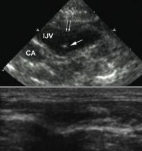 Figure 36 Ring-down artifact of the needle within the lumen of the blood vessel.
