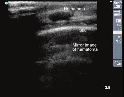 in location, intensity, or to actual structures in the patient. Although artifacts can cause false images, they can also allow the sonographer to more readily identify particular structures.