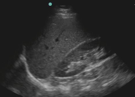 Note the absence of a normal mirror-image artifact of the liver; alternatively, one may visualize the collection of anechoic fluid above the diaphragm. B.