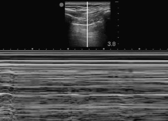 Ultrasonography cannot easily see the tube within the trachea; rather, confirmation relies on the absence of a tube within the esophagus, which appears as a