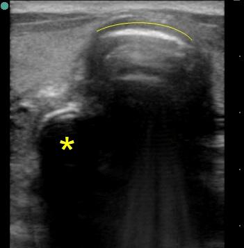 Note the absence of sliding (the stratosphere appearance) on the left lung, suggesting a pneumothorax or, in this case, no ventilation due to a right mainstem intubation.