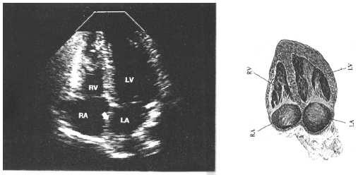 Image Generation Image Generation A-Mode (5) B-Mode (6) Fig. 5.2: A-mode Ultrasound The B-Mode or Brightness-Mode encodes the reflected echo strength as grey-values (corrected for the image depth).