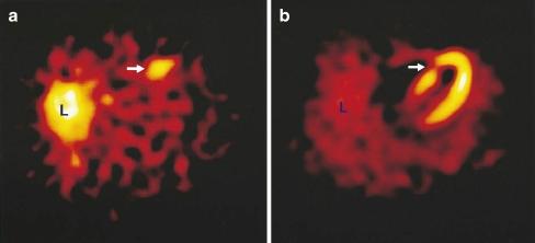 Apoptosis imaging Annexin A5: is used in biomedical research to stain apoptotic cells labeled with 99 Tc it has been used to visualize