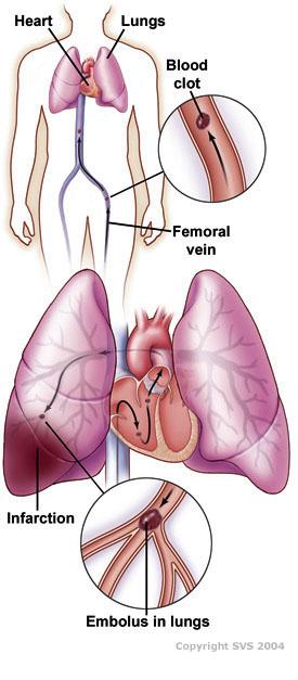 Haematology Venous thromboembolism (VTE): blood clot in