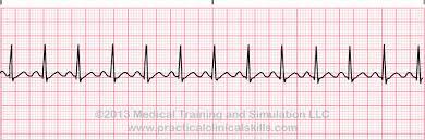 ABNORMAL ECG READINGS Bradycardia is a heartbeat that is too slow, the ECG will show an inverted T wave.
