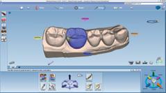 bridges Fully automated design from an anatomic tooth