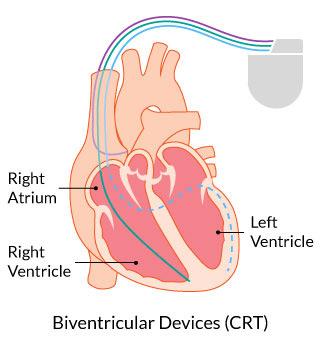 and left ventricular simultaneously Left ventricular lead