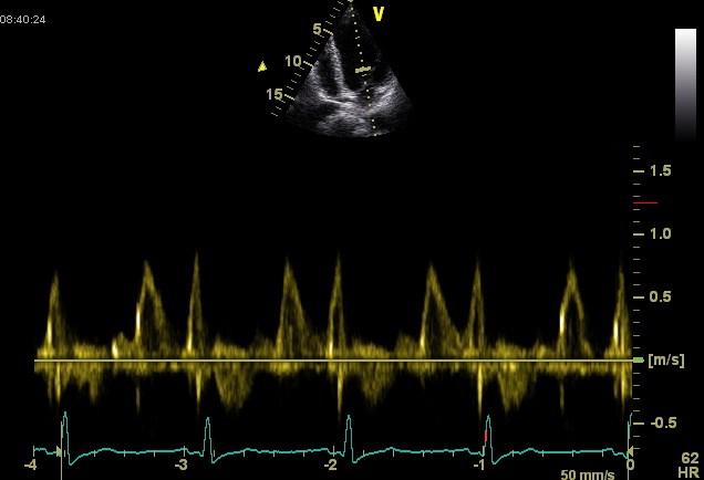 Normal diastolic function Rapid early filling with little atrial contribution rapid relaxation of ventricle vigorous elastic recoil (suction)