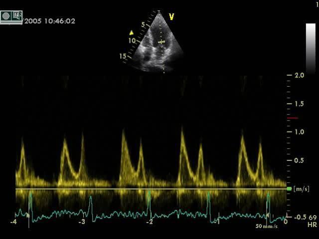 Moderate diastolic dysfunction Abnormal relaxation (stiff ventricle)