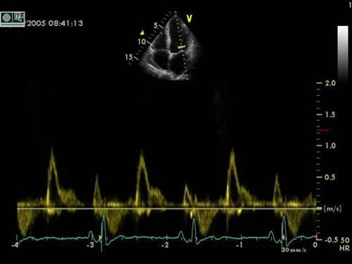 Severe diastolic dysfunction High LA pressure leads to early MV opening Rapid early filling of stiff ventricle Pressures equalise