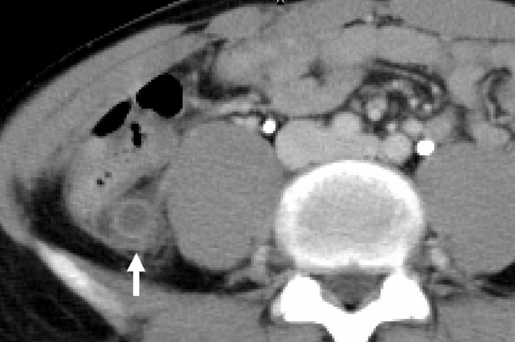 contrast-enhanced CT in a case of proven appendicitis.