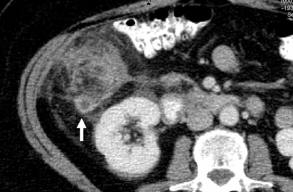 lack arrow in shows periappendiceal stranding. lumen. One or more appendicolith was seen in 28% (16 of 57) of patients with appendicitis (Figure 5).