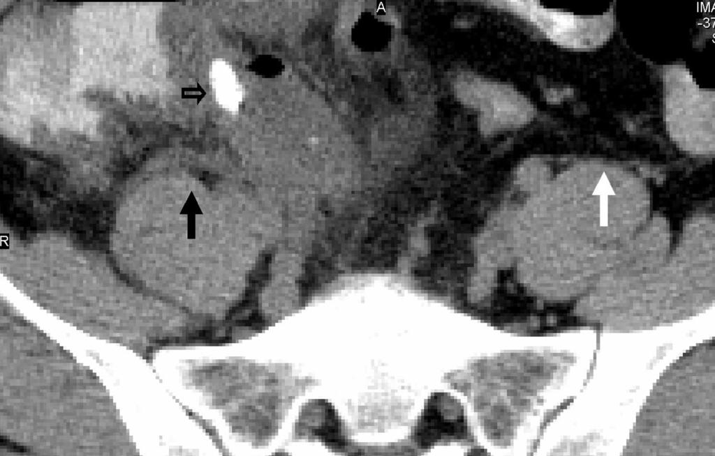 CT OF CUTE PPENDICITIS FIGURE 7. 35-year-old man with right lower quadrant pain, leukocytosis, and proven appendicitis. () Small arrow indicates a calcified appendicolith.