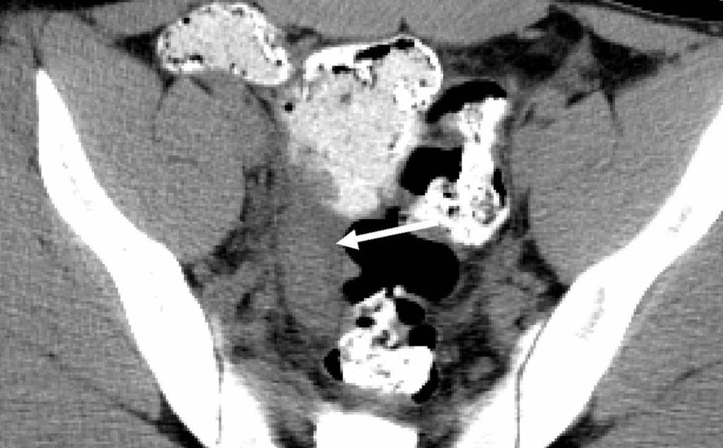 21-year-old man with abdominal pain, fever, and proven appendicitis. () White arrow shows a low-lying enlarged appendix in the pelvis without periappendiceal stranding.
