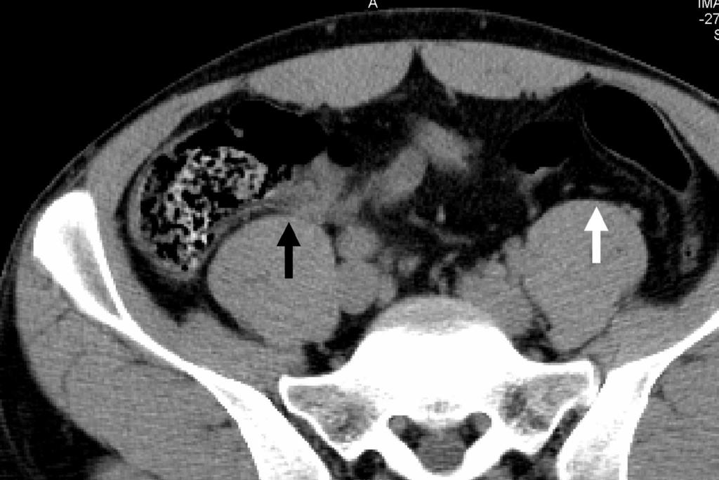 6 cm and <1 cm was noted in 51% (29); and a diameter >1 cm was seen in 1% (1). Discussion FIGURE 9. 29-year-old woman with abdominal pain and proven appendicitis.