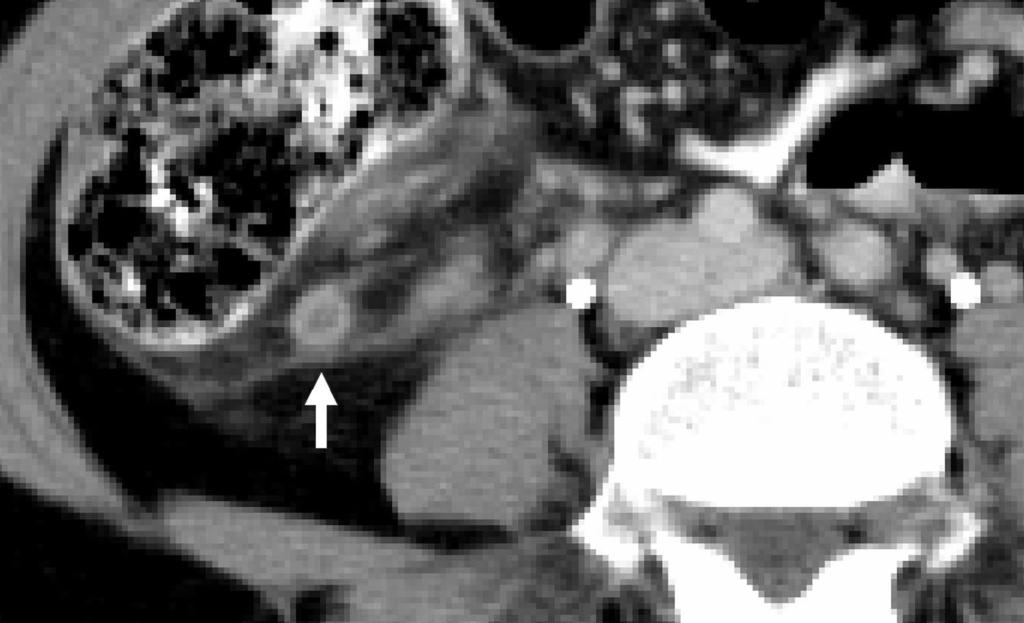 CT OF CUTE PPENDICITIS FIGURE 10. 40-year-old woman complaining of right lower quadrant pain.