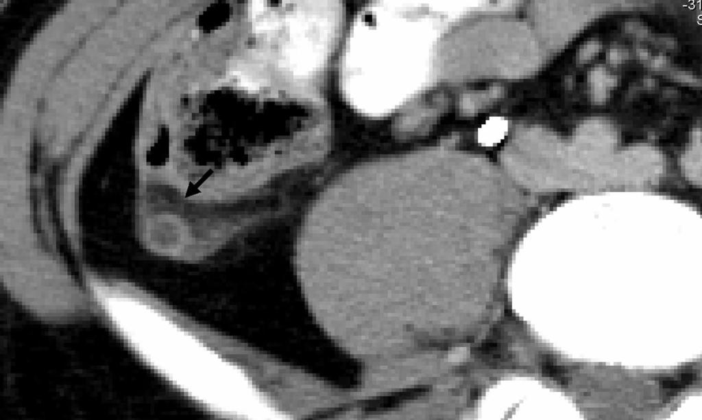 () White arrow shows an enlarged retrocecal appendix.