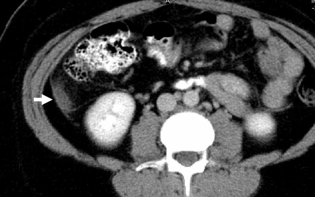 normal appendix on CT is seen as a tubular structure, linear or curved with a blinded end arising from the posteromedial