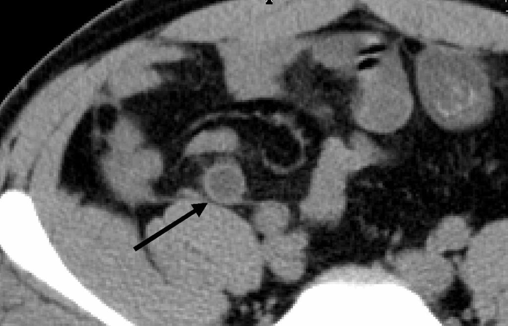 CT OF CUTE PPENDICITIS FIGURE 13. 22-year-old man with right lower quadrant pain and proven appendicitis.