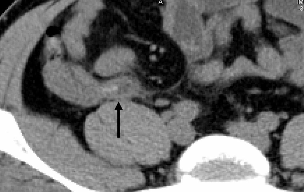 () lack arrows point to the cecal appendiceal opening that appears to be obstructed by a hyperdense intraluminal structure.