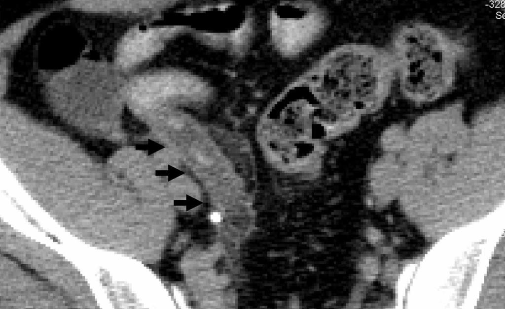 White arrows indicate a low-lying appendix in the pelvis and no evidence of periappendiceal stranding. FIGURE 16.
