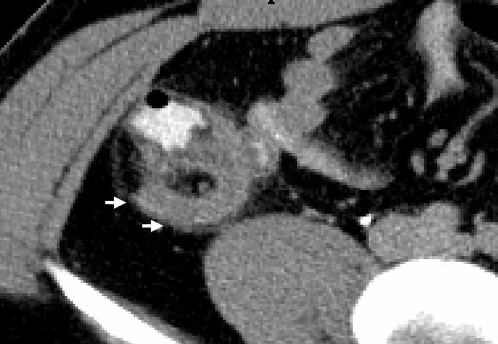 CT OF CUTE PPENDICITIS FIGURE 17. 45-year-old woman with abdominal pain. CT demonstrates a normal contrast-filled subhepatic appendix. FIGURE 18.